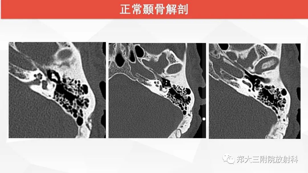【PPT】耳硬化症的影像诊断