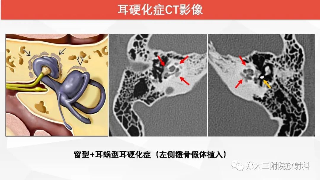 【PPT】耳硬化症的影像诊断