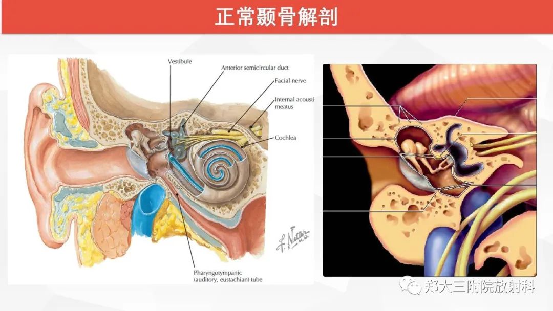 【PPT】耳硬化症的影像诊断