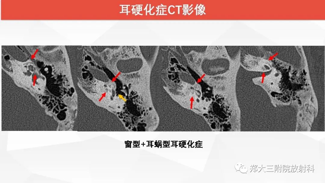 【PPT】耳硬化症的影像诊断