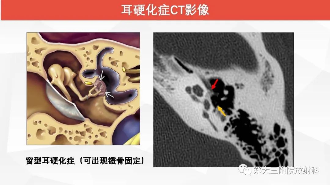 【PPT】耳硬化症的影像诊断