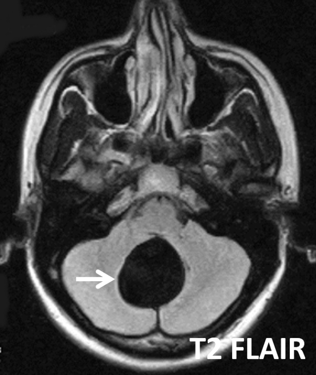 【病例】Blake囊肿1例MR影像表现