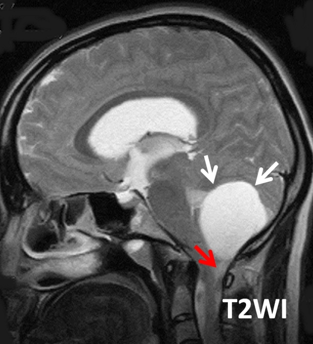 【病例】Blake囊肿1例MR影像表现