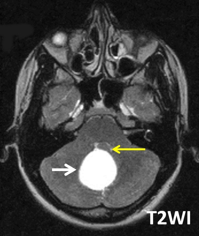 【病例】Blake囊肿1例MR影像表现