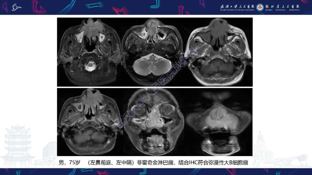 【PPT】鼻腔鼻窦神经内分泌癌影像诊断及鉴别诊断-31