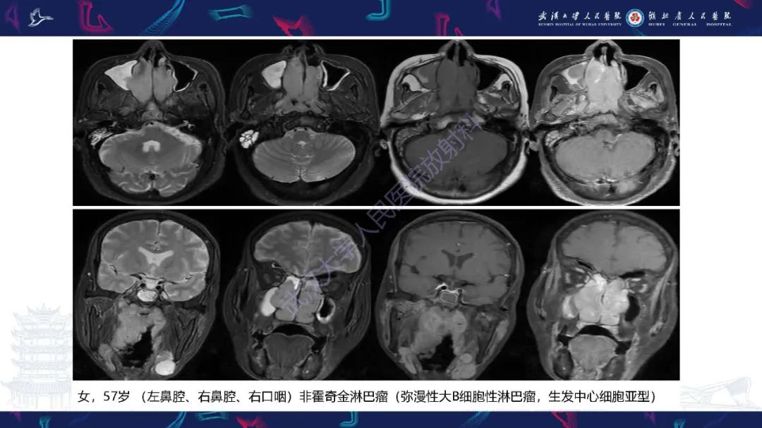 【PPT】鼻腔鼻窦神经内分泌癌影像诊断及鉴别诊断-30