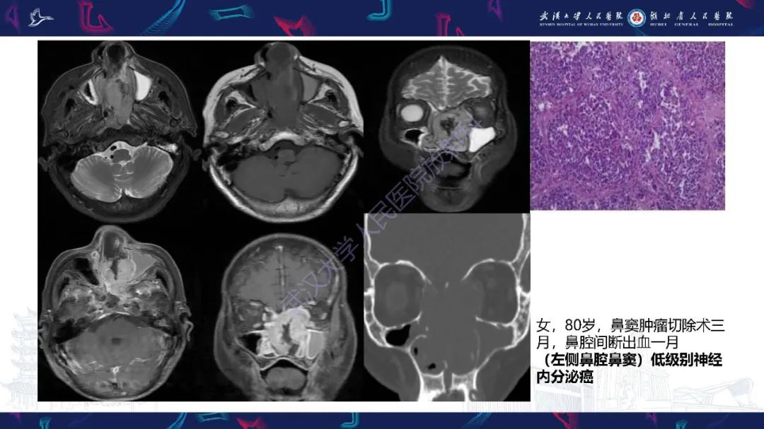【PPT】鼻腔鼻窦神经内分泌癌影像诊断及鉴别诊断-10
