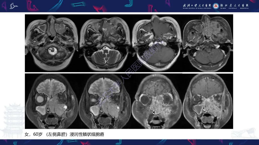 【PPT】鼻腔鼻窦神经内分泌癌影像诊断及鉴别诊断-13