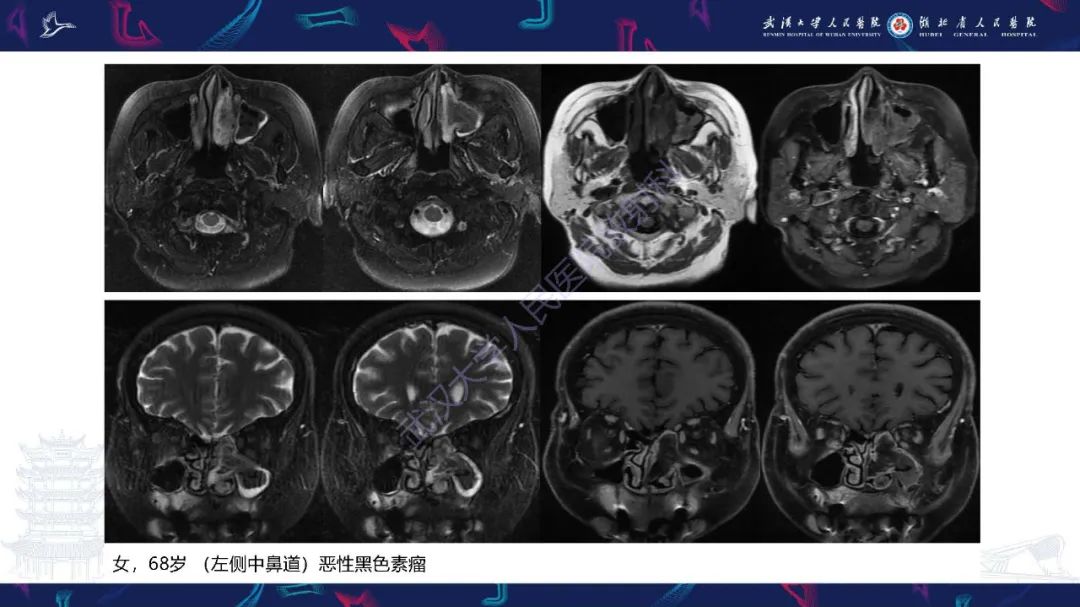 【PPT】鼻腔鼻窦神经内分泌癌影像诊断及鉴别诊断-37
