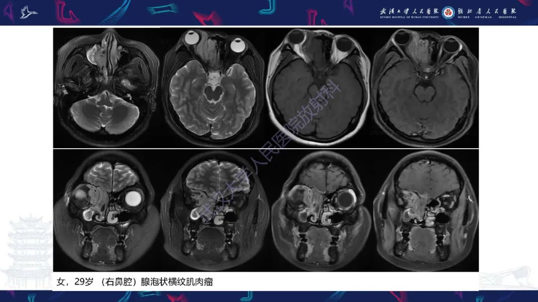 【PPT】鼻腔鼻窦神经内分泌癌影像诊断及鉴别诊断-22