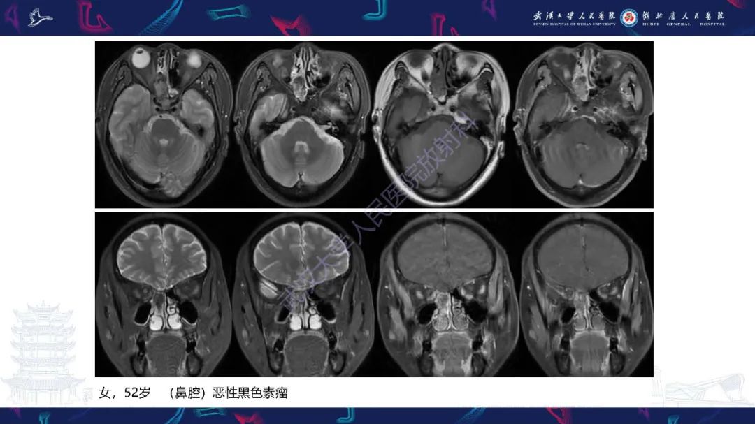 【PPT】鼻腔鼻窦神经内分泌癌影像诊断及鉴别诊断-35