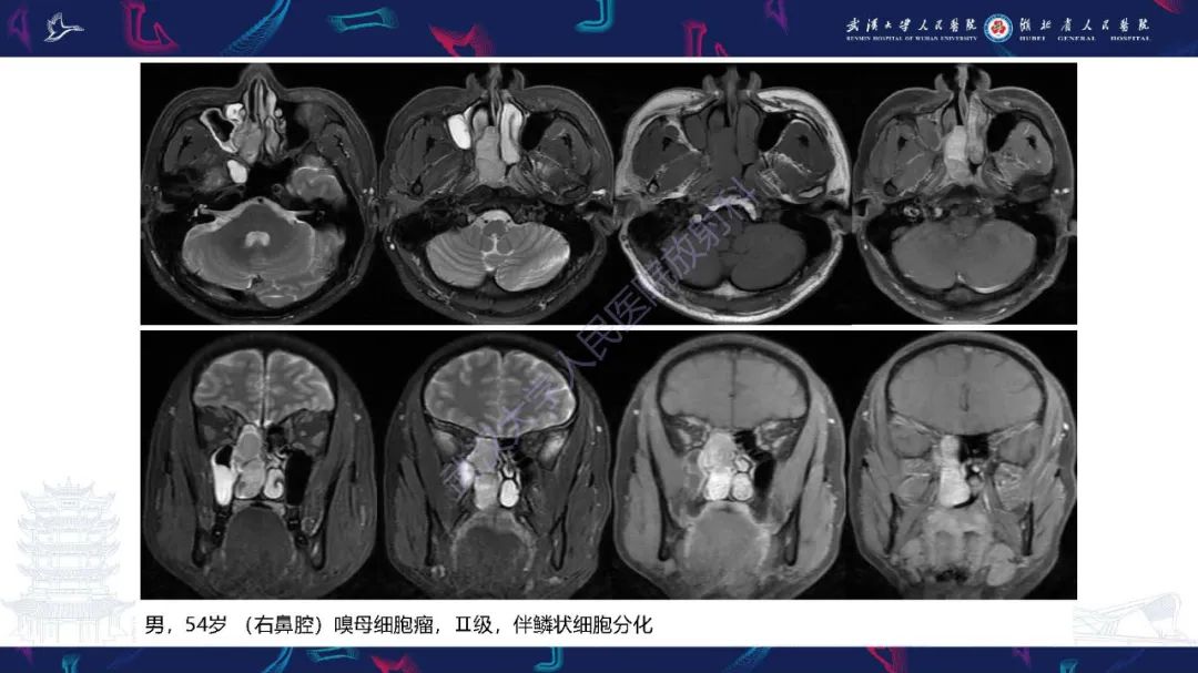 【PPT】鼻腔鼻窦神经内分泌癌影像诊断及鉴别诊断-27