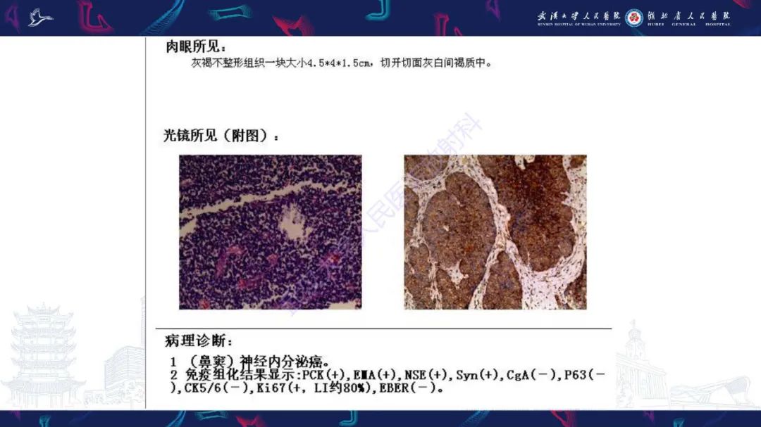 【PPT】鼻腔鼻窦神经内分泌癌影像诊断及鉴别诊断-9