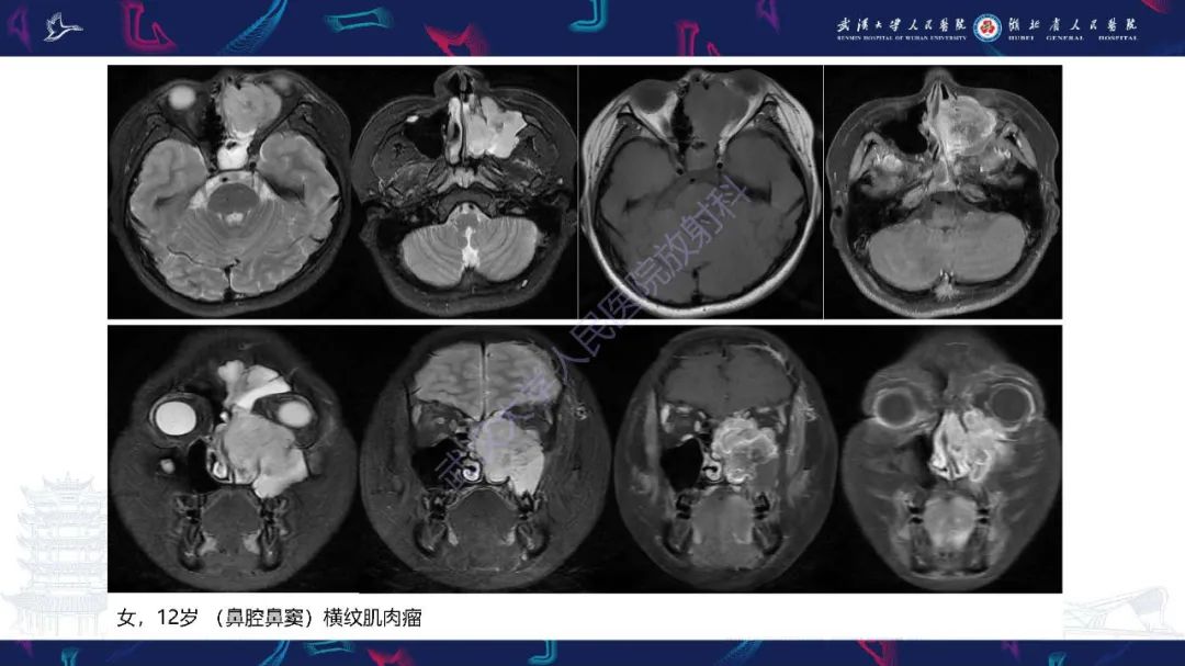 【PPT】鼻腔鼻窦神经内分泌癌影像诊断及鉴别诊断-23