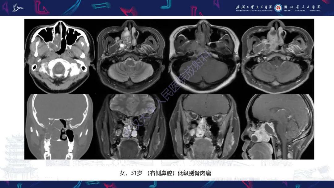 【PPT】鼻腔鼻窦神经内分泌癌影像诊断及鉴别诊断-19