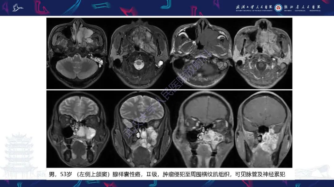 【PPT】鼻腔鼻窦神经内分泌癌影像诊断及鉴别诊断-16