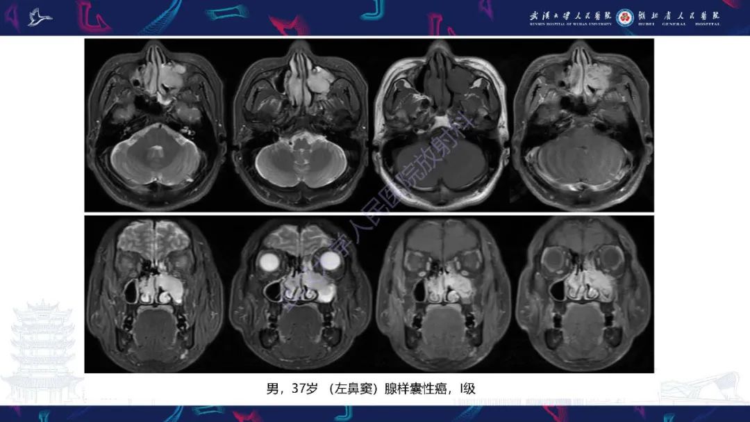 【PPT】鼻腔鼻窦神经内分泌癌影像诊断及鉴别诊断-15