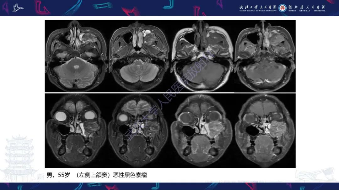 【PPT】鼻腔鼻窦神经内分泌癌影像诊断及鉴别诊断-36