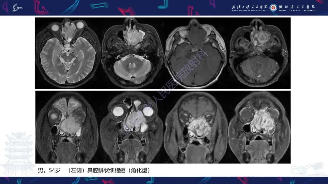 【PPT】鼻腔鼻窦神经内分泌癌影像诊断及鉴别诊断-14