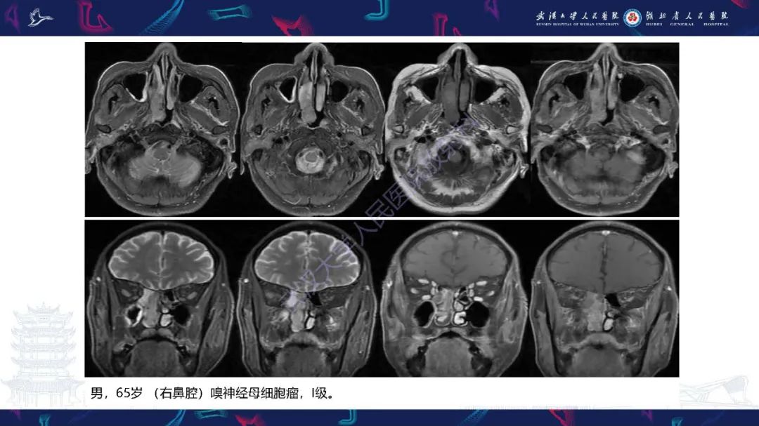 【PPT】鼻腔鼻窦神经内分泌癌影像诊断及鉴别诊断-26