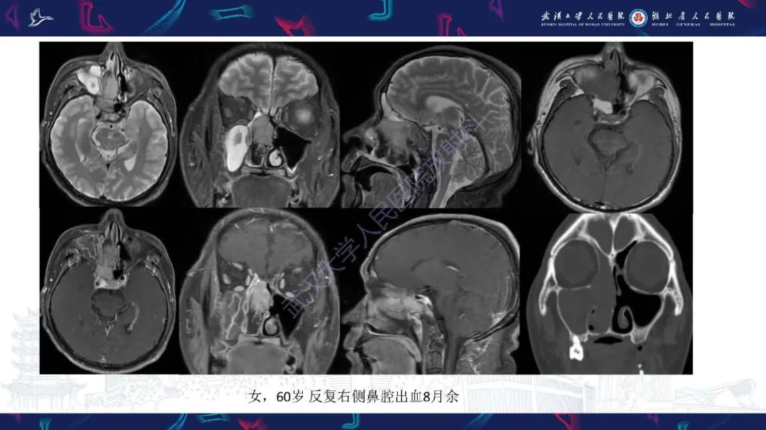 【PPT】鼻腔鼻窦神经内分泌癌影像诊断及鉴别诊断-7