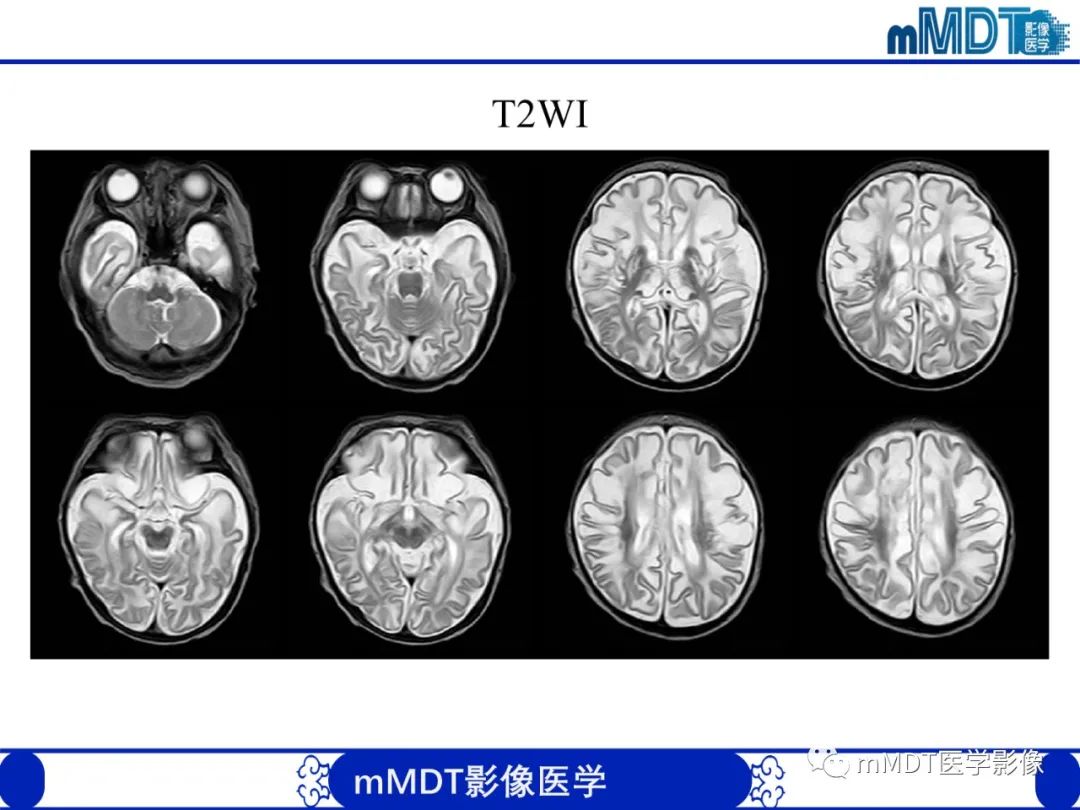 【PPT】新生儿HIE影像学表现-43
