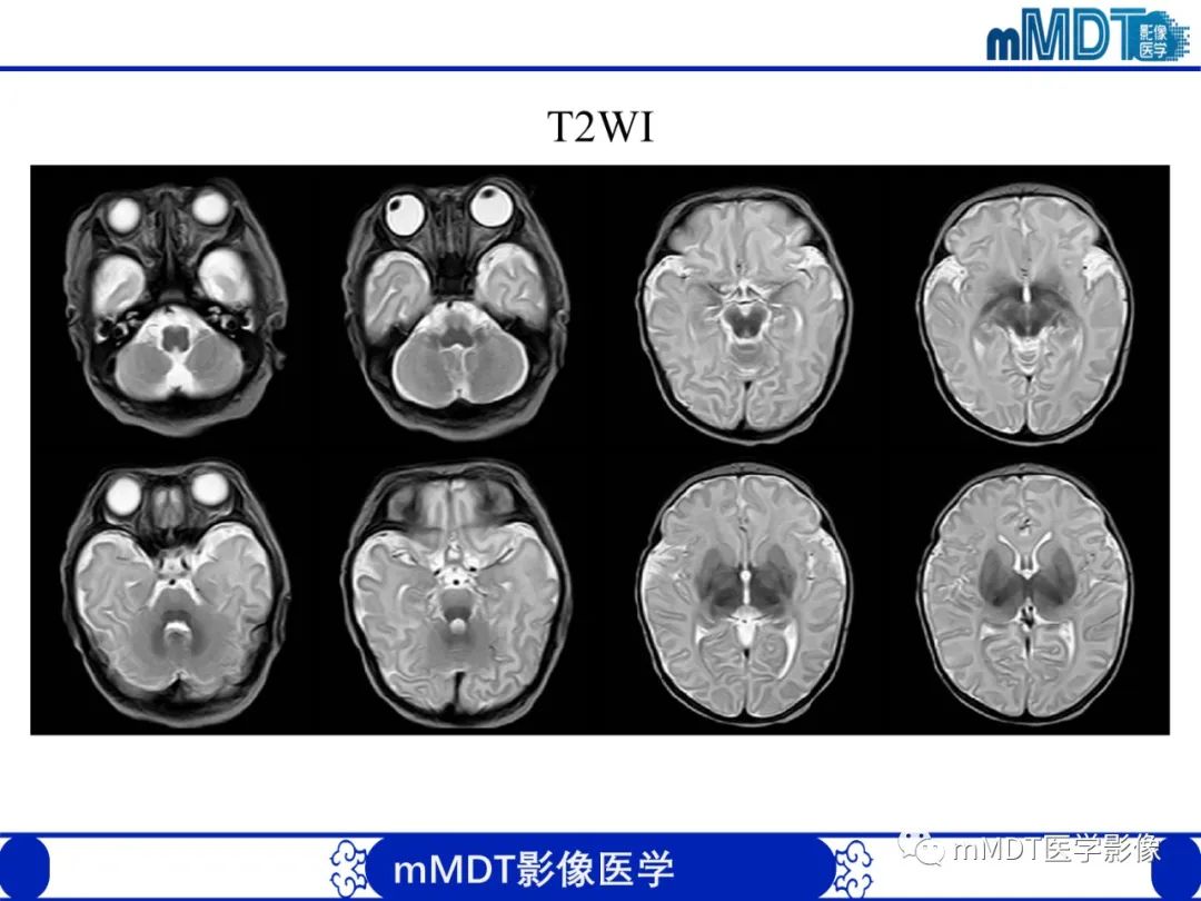 【PPT】新生儿HIE影像学表现-34