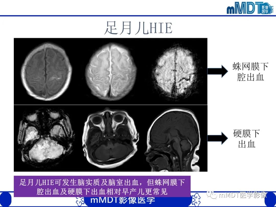 【PPT】新生儿HIE影像学表现-47