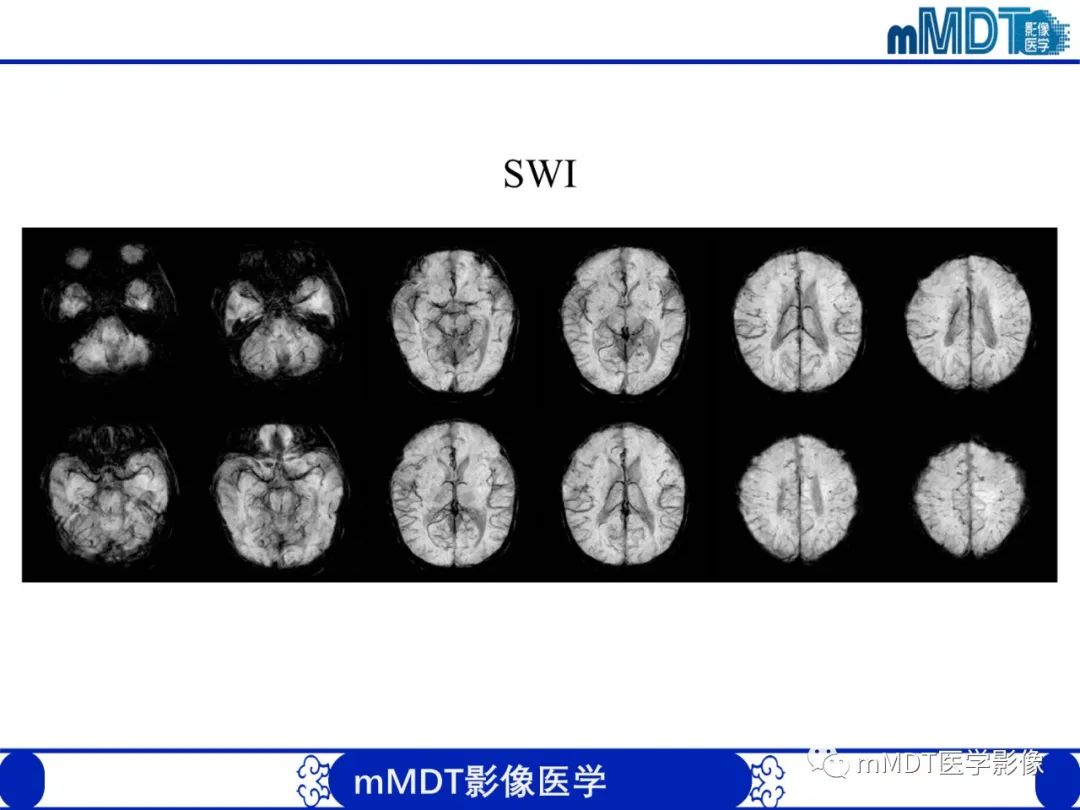 【PPT】新生儿HIE影像学表现-38
