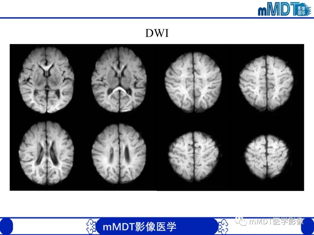 【PPT】新生儿HIE影像学表现-37