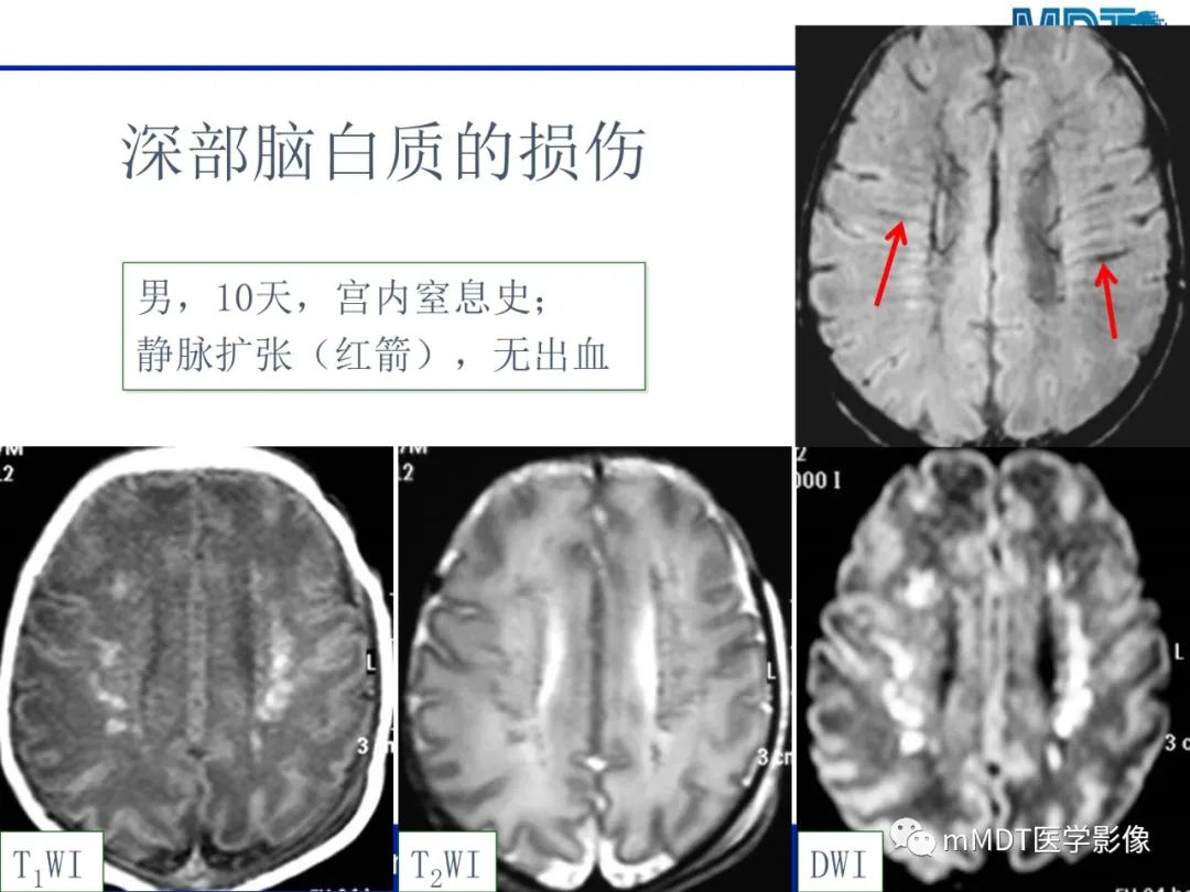 【PPT】新生儿HIE影像学表现-26