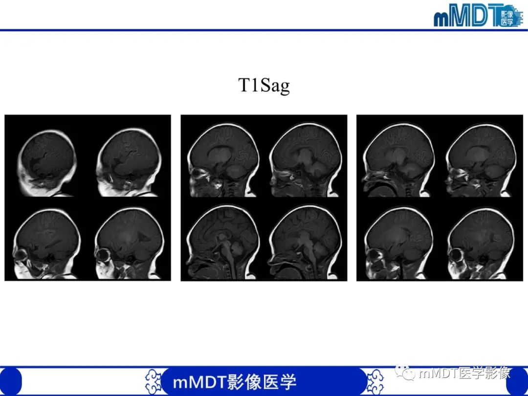 【PPT】新生儿HIE影像学表现-39