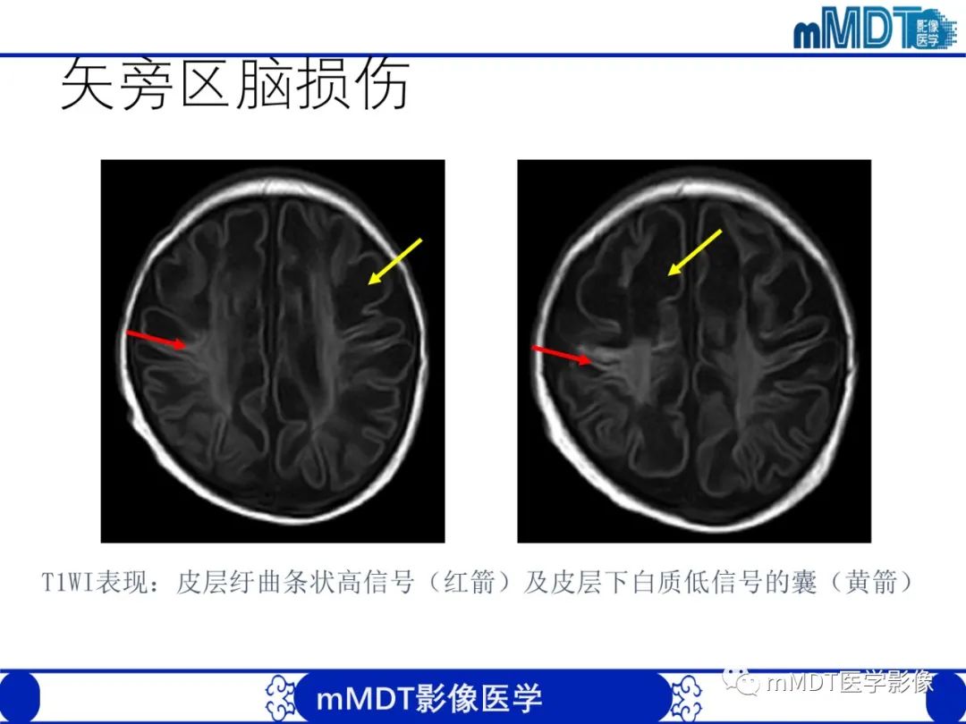 【PPT】新生儿HIE影像学表现-22