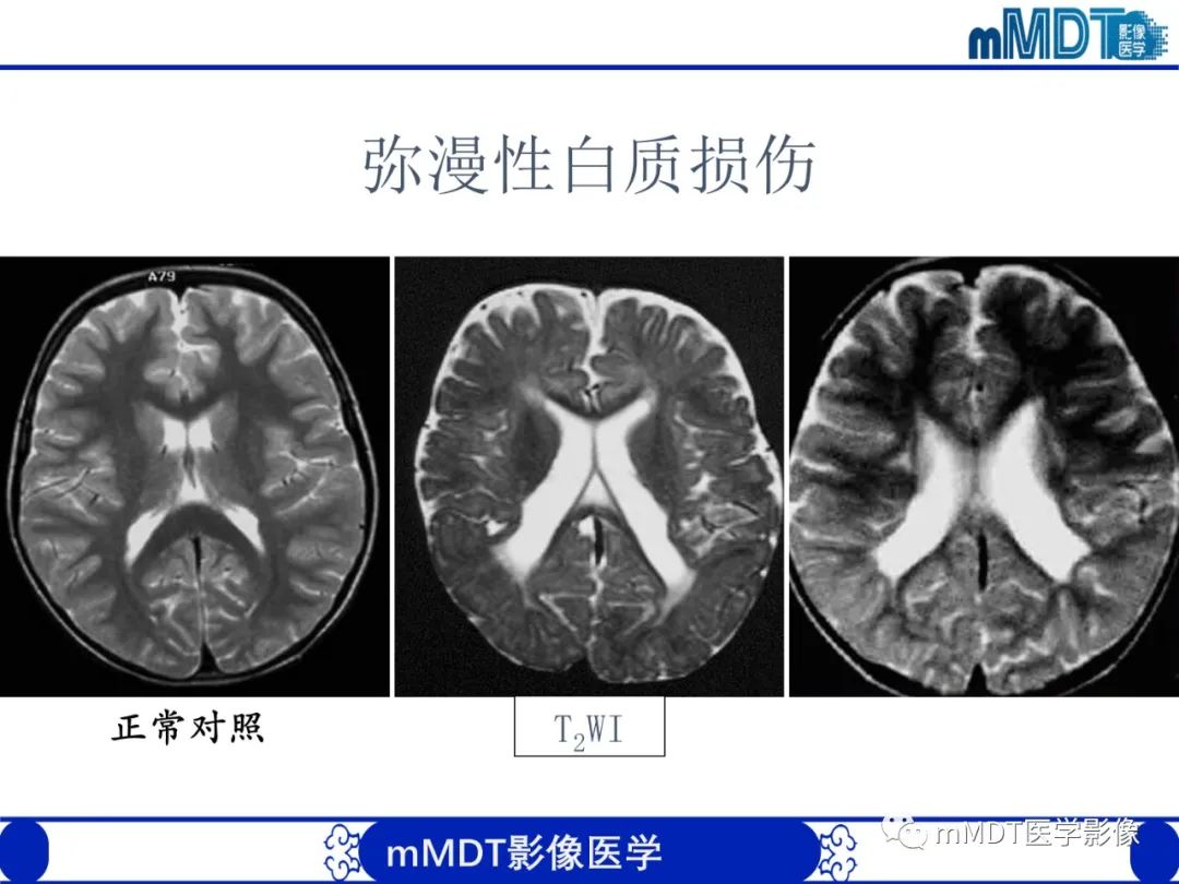 【PPT】新生儿HIE影像学表现-17
