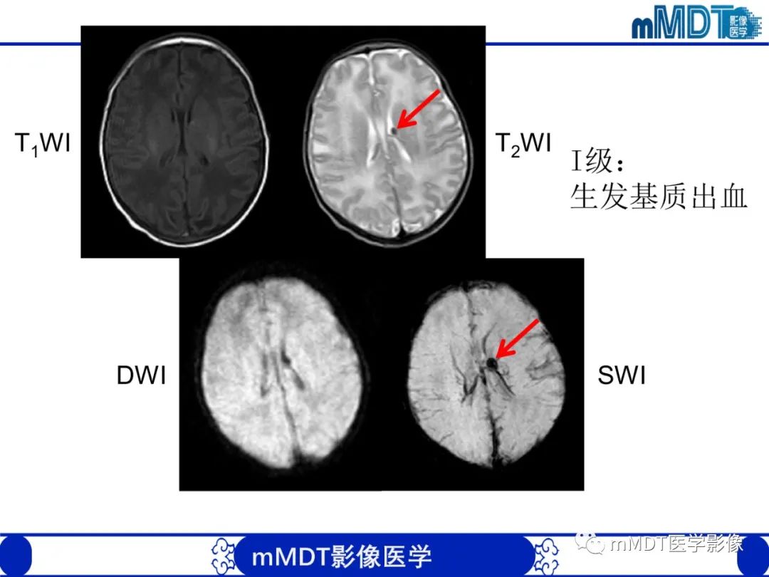 【PPT】新生儿HIE影像学表现-9