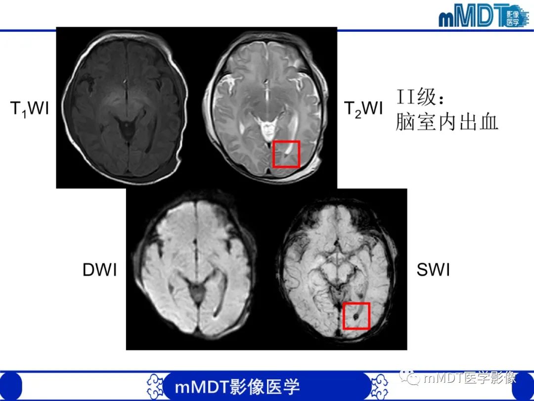 【PPT】新生儿HIE影像学表现-10