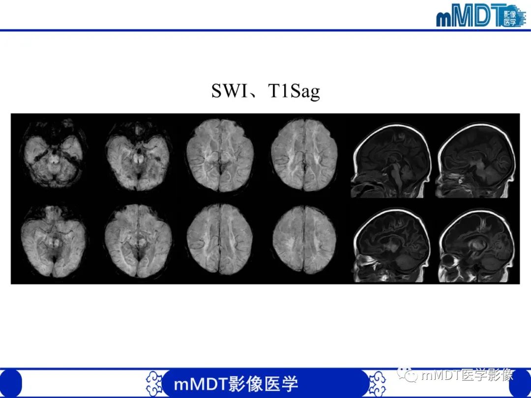 【PPT】新生儿HIE影像学表现-45