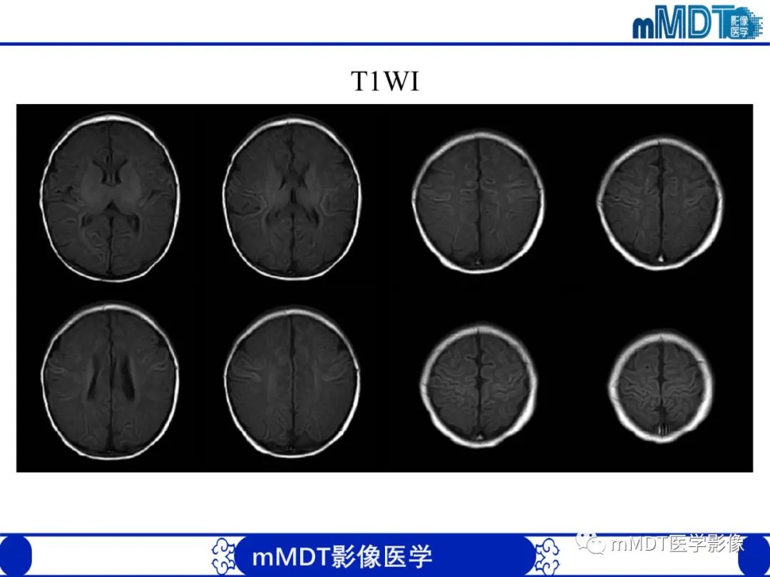 【PPT】新生儿HIE影像学表现-33