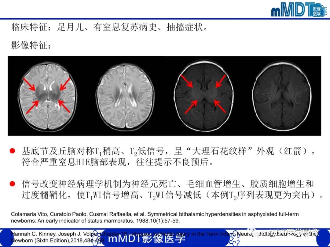 【PPT】新生儿HIE影像学表现-40