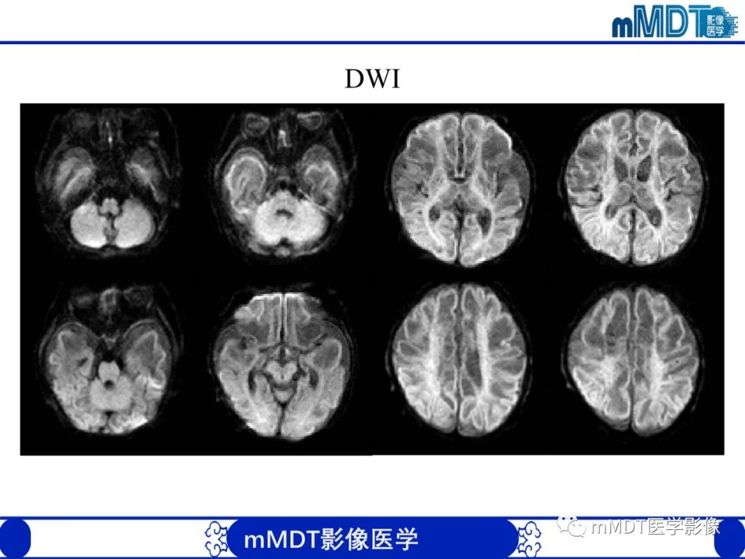 【PPT】新生儿HIE影像学表现-44