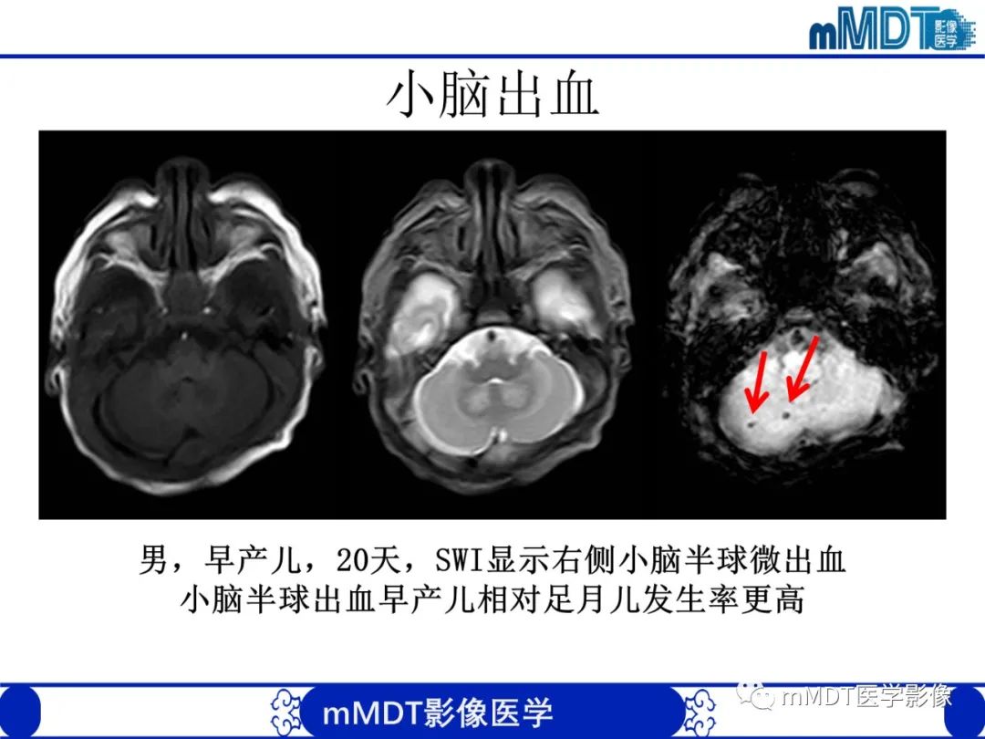 【PPT】新生儿HIE影像学表现-13