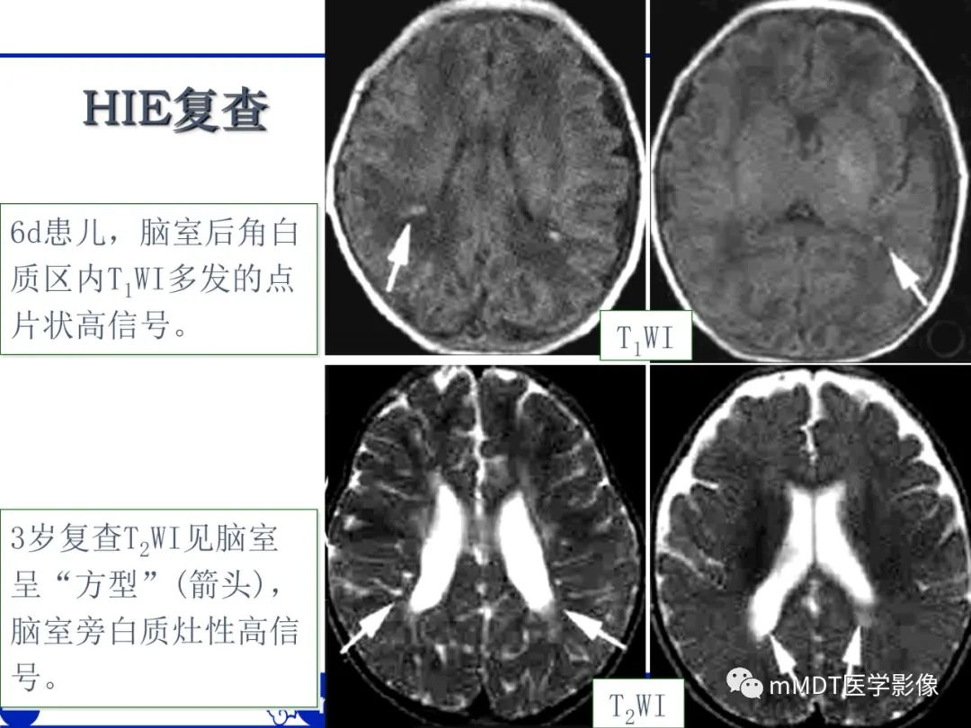 【PPT】新生儿HIE影像学表现-27