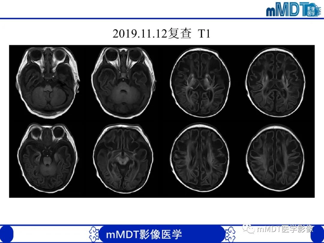 【PPT】新生儿HIE影像学表现-42