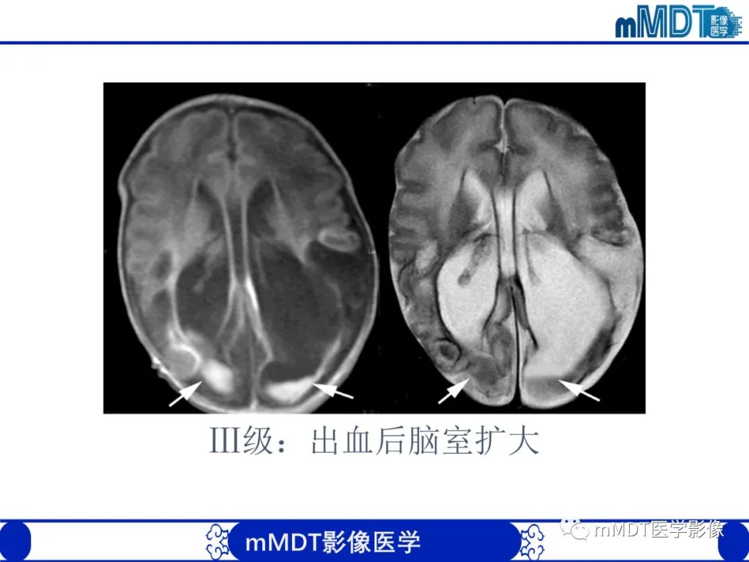 【PPT】新生儿HIE影像学表现-11