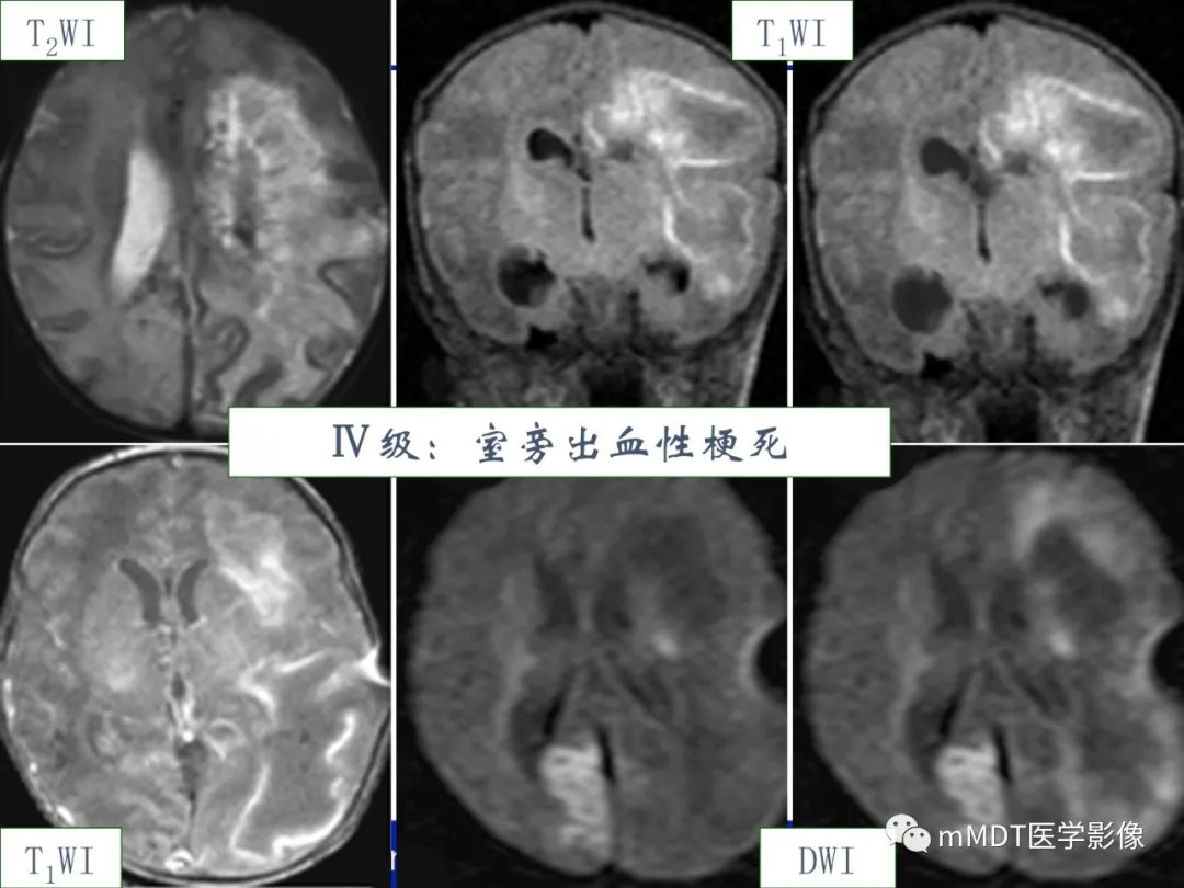 【PPT】新生儿HIE影像学表现-12
