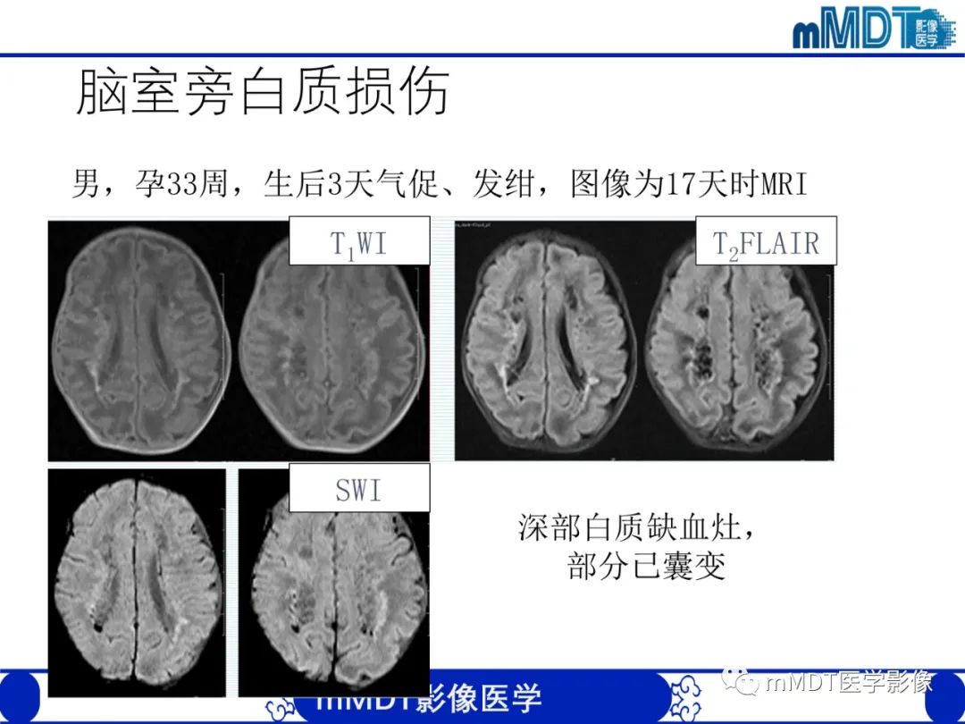 【PPT】新生儿HIE影像学表现-15
