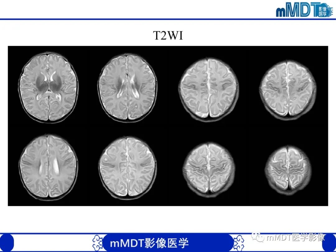 【PPT】新生儿HIE影像学表现-35
