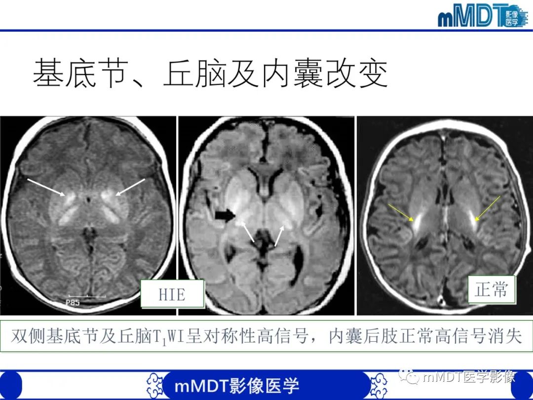 【PPT】新生儿HIE影像学表现-30