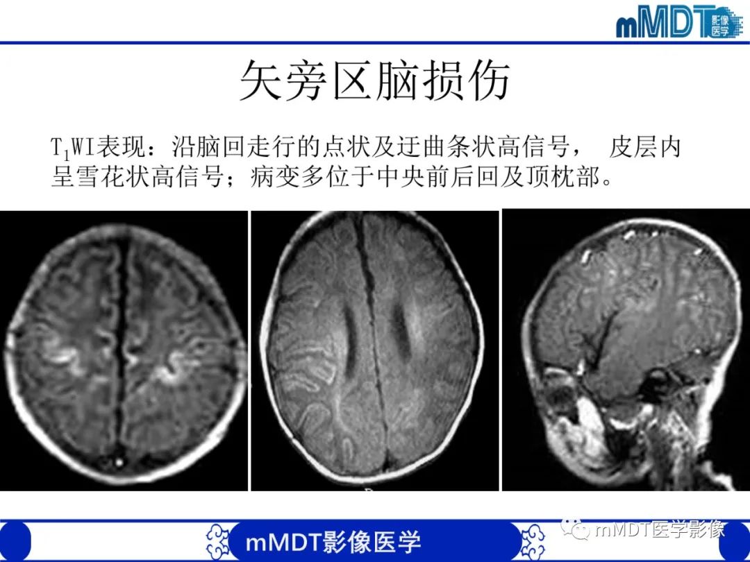 【PPT】新生儿HIE影像学表现-20