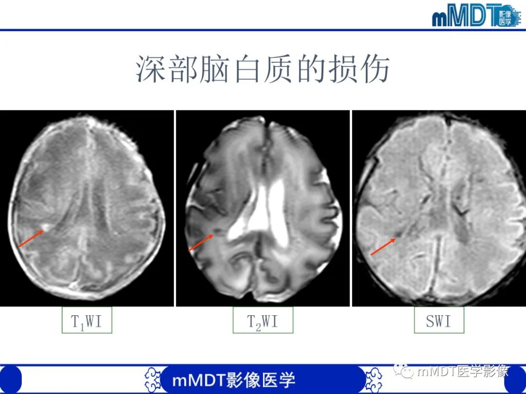 【PPT】新生儿HIE影像学表现-24